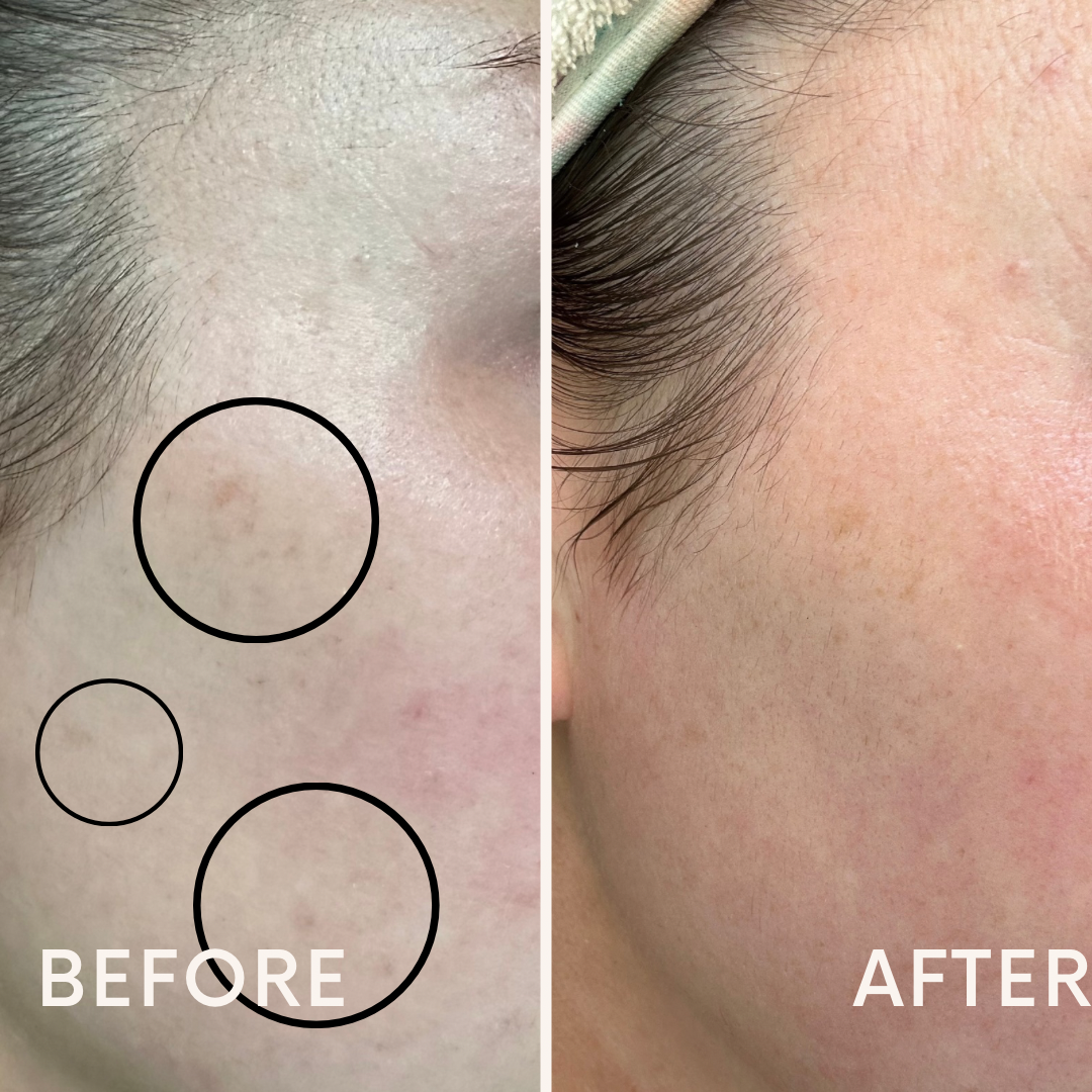 One month dark spot update