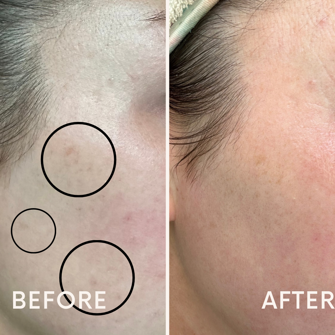 One month dark spot update 